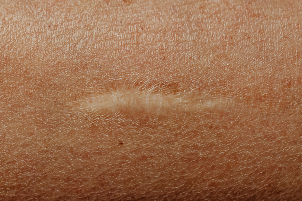 mohs scar - Pacifica Center For Plastic Surgery mohs scar