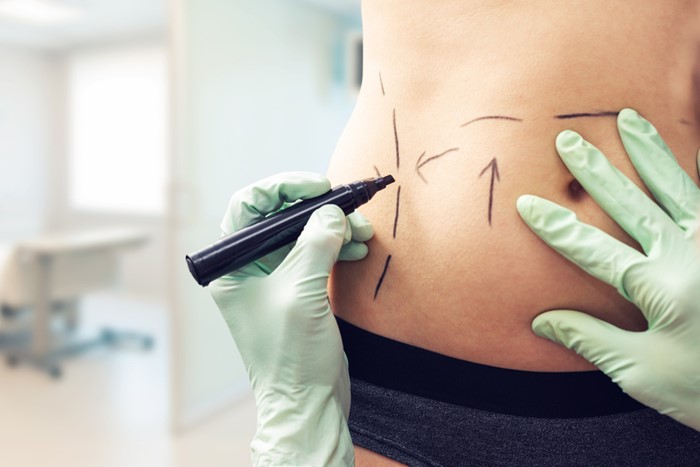 Frequently Asked Questions About Tummy Tuck Surgery Procedures